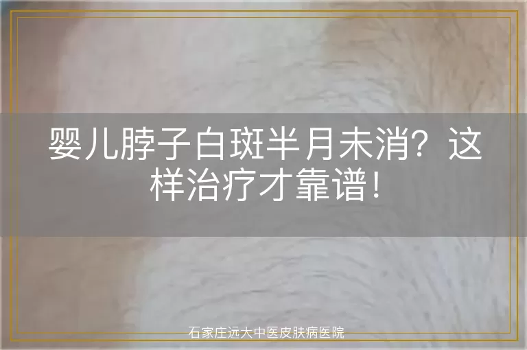 婴儿脖子白斑半月未消？这样治疗才靠谱！