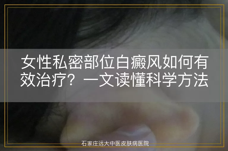 女性私密部位白癜风如何有效治疗？一文读懂科学方法