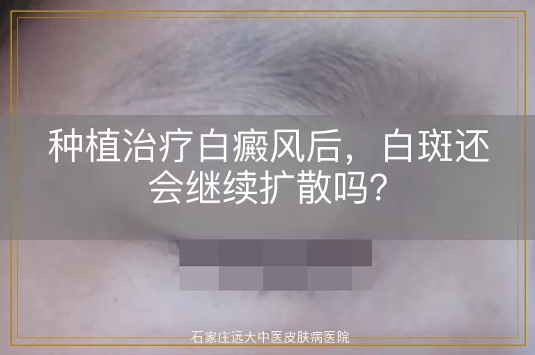 种植治疗白癜风后，白斑还会继续扩散吗？