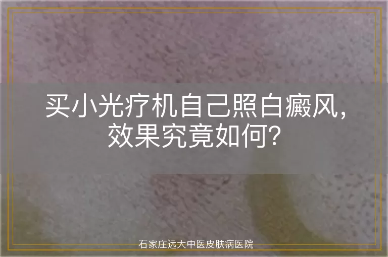 买小光疗机自己照白癜风，效果究竟如何？