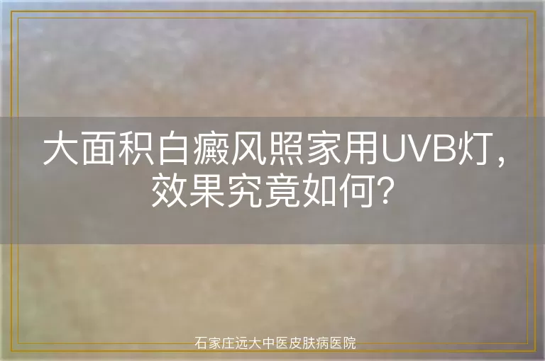 大面积白癜风照家用UVB灯，效果究竟如何？