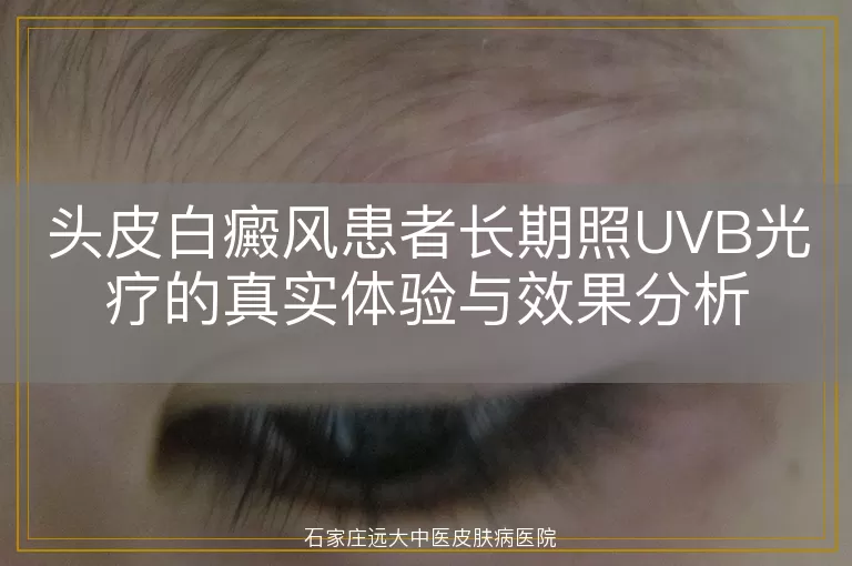 头皮白癜风患者长期照UVB光疗的真实体验与效果分析