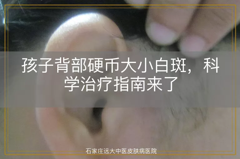 孩子背部硬币大小白斑，科学治疗指南来了