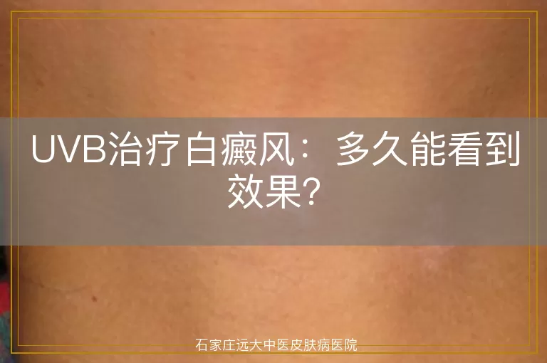 UVB治疗白癜风：多久能看到效果？