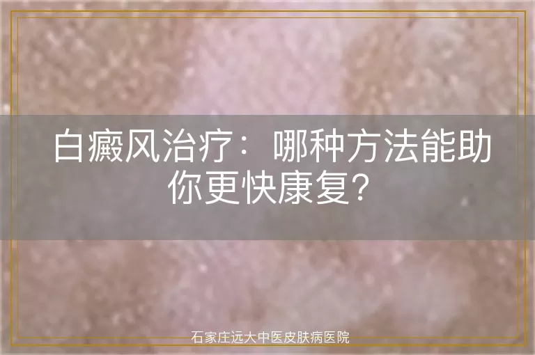 白癜风治疗：哪种方法能助你更快康复？