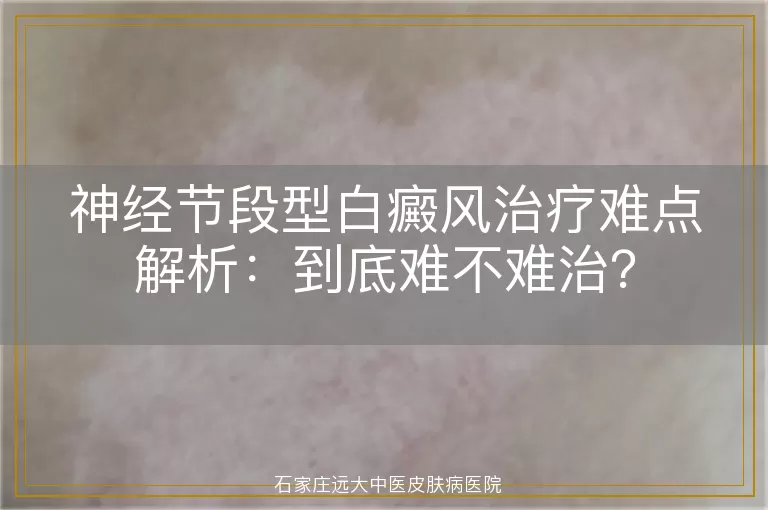 神经节段型白癜风治疗难点解析：到底难不难治？