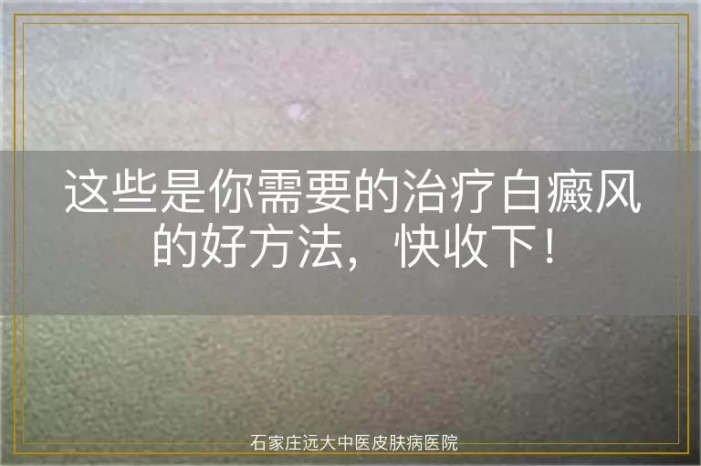这些是你需要的治疗白癜风的好方法，快收下！
