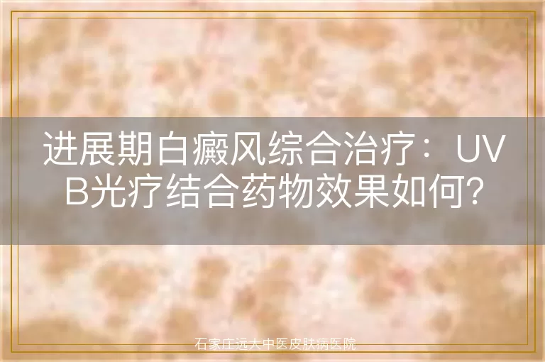 进展期白癜风综合治疗：UVB光疗结合药物效果如何？