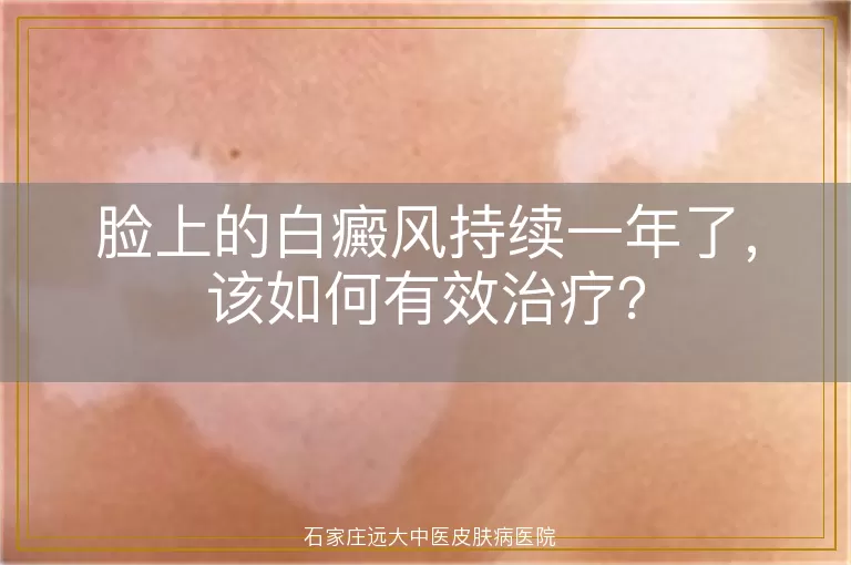 脸上的白癜风持续一年了，该如何有效治疗？