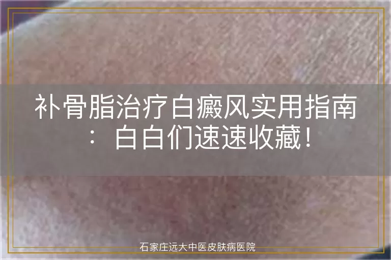 补骨脂治疗白癜风实用指南：白白们速速收藏！