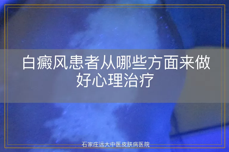 白癜风患者从哪些方面来做好心理治疗