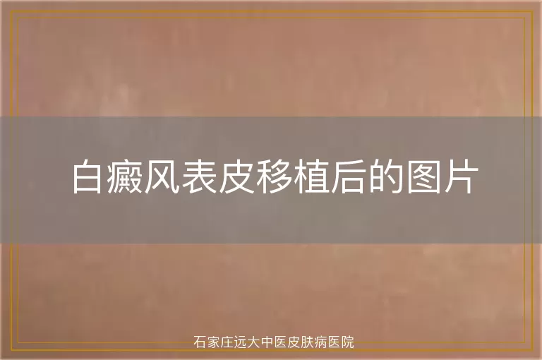 白癜风表皮移植后的图片