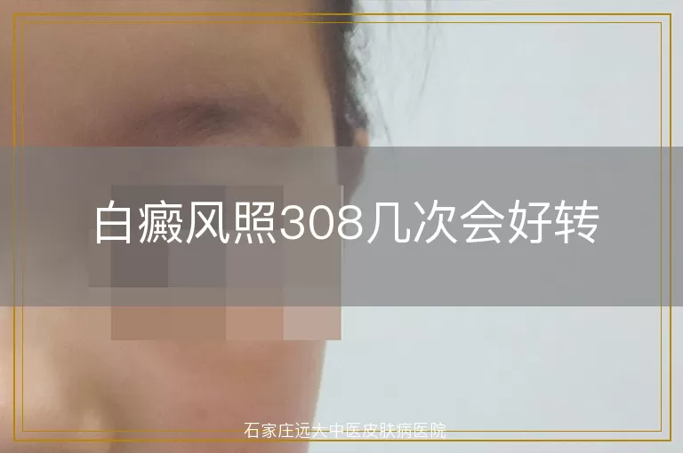 白癜风照308几次会好转