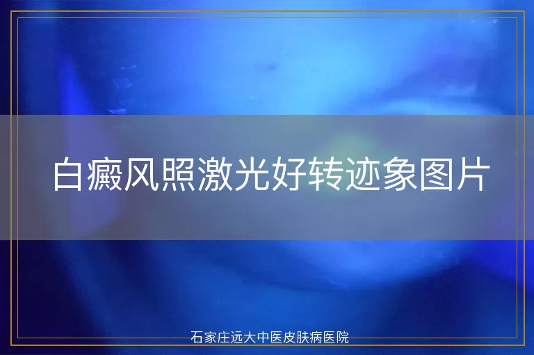 白癜风照激光好转迹象图片