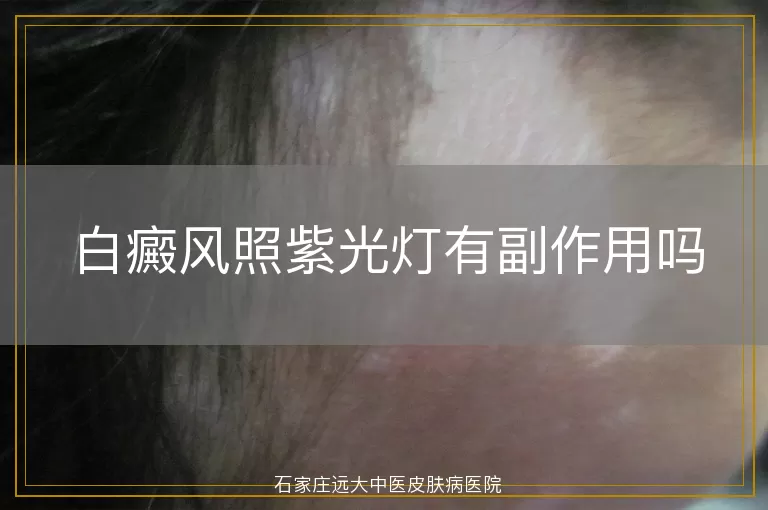 白癜风照紫光灯有副作用吗