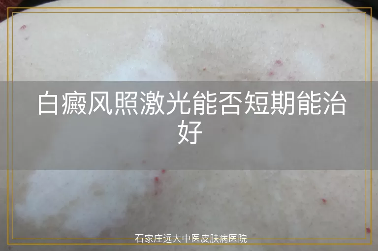 白癜风照激光能否短期能治好