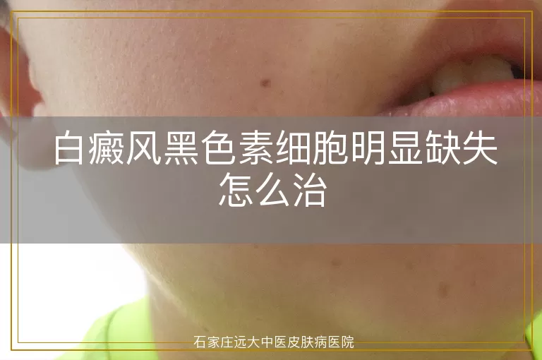 白癜风黑色素细胞明显缺失怎么治