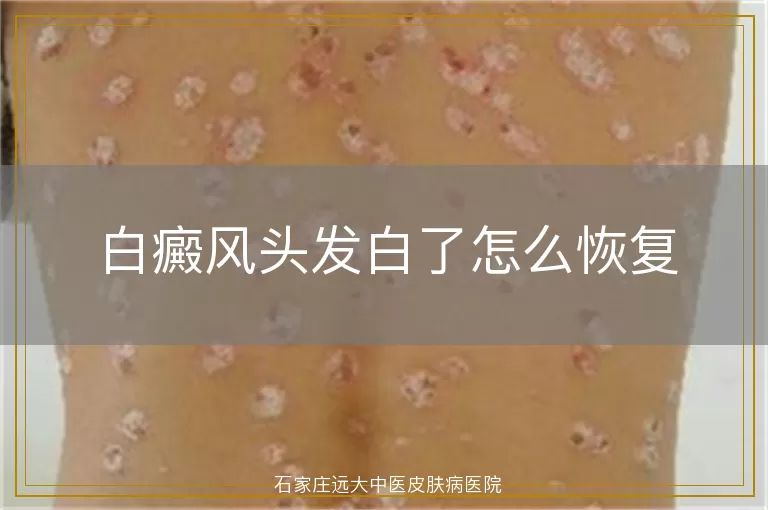 白癜风头发白了怎么恢复