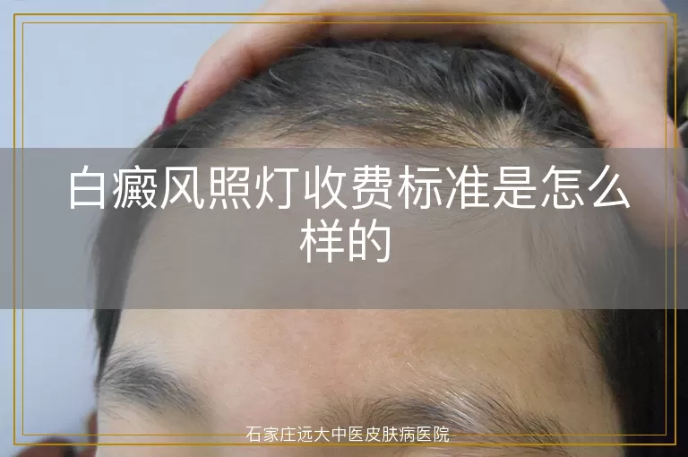 白癜风照灯收费标准是怎么样的
