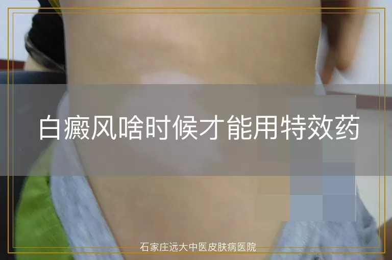 白癜风啥时候才能用特效药