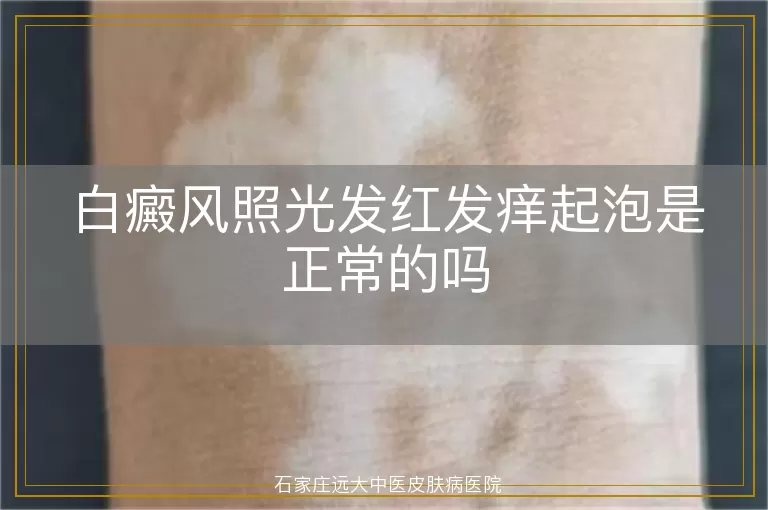 白癜风照光发红发痒起泡是正常的吗