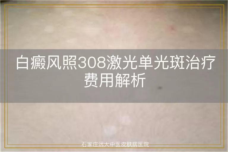 白癜风照308激光单光斑治疗费用解析