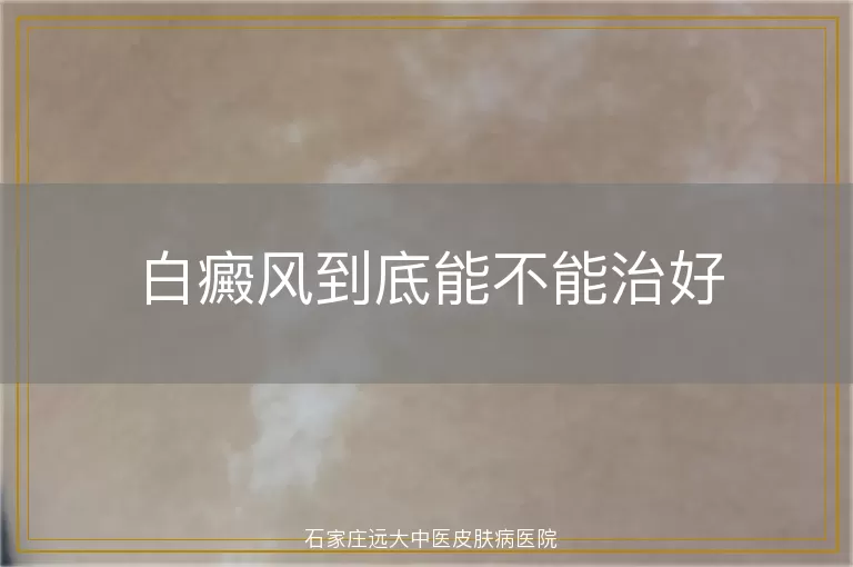 白癜风到底能不能治好