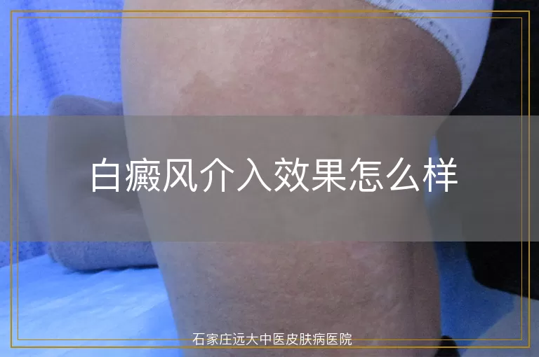 白癜风介入效果怎么样