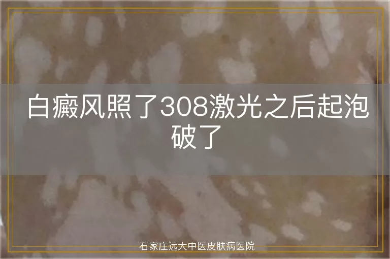 白癜风照了308激光之后起泡破了