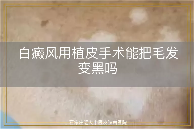 白癜风用植皮手术能把毛发变黑吗