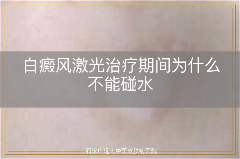 白癜风激光治疗期间为什么不能碰水