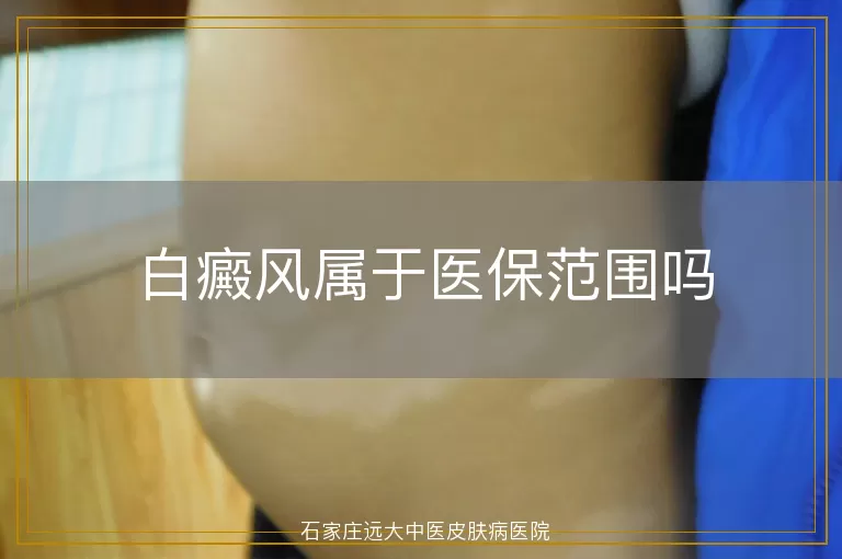白癜风属于医保范围吗