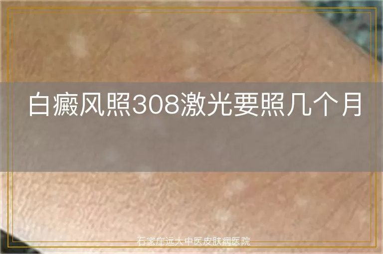 白癜风照308激光要照几个月