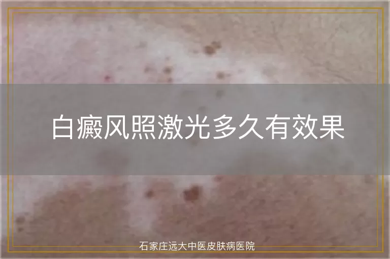 白癜风照激光多久有效果