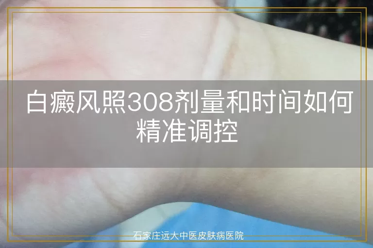 白癜风照308剂量和时间如何精准调控