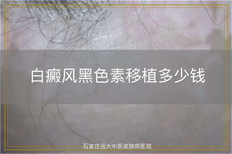 白癜风黑色素移植多少钱