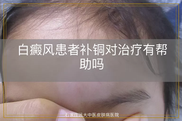 白癜风患者补铜对治疗有帮助吗