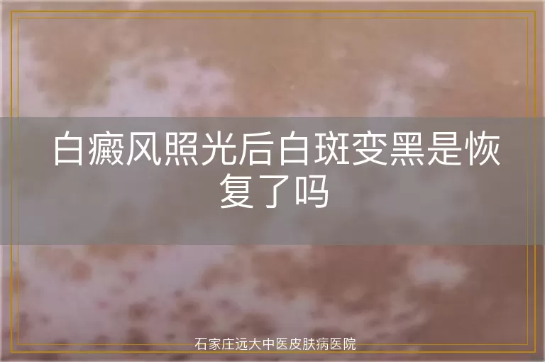 白癜风照光后白斑变黑是恢复了吗