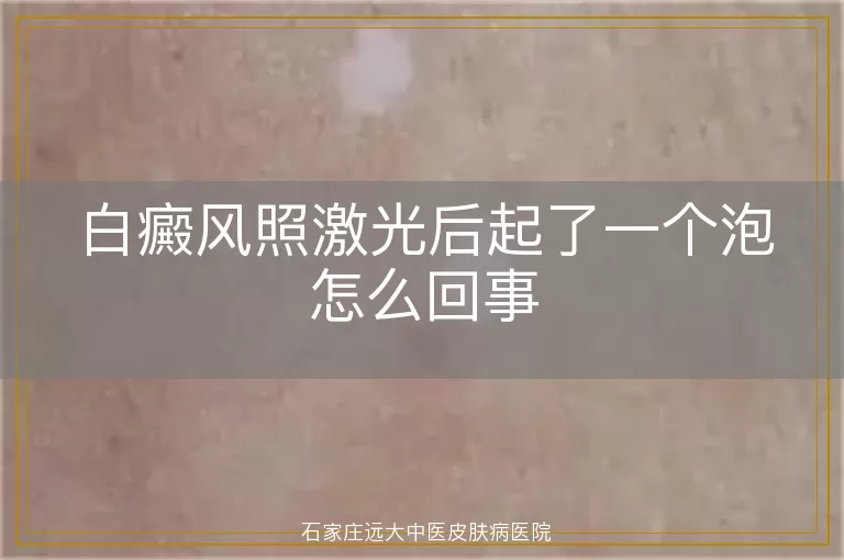 白癜风照激光后起了一个泡怎么回事