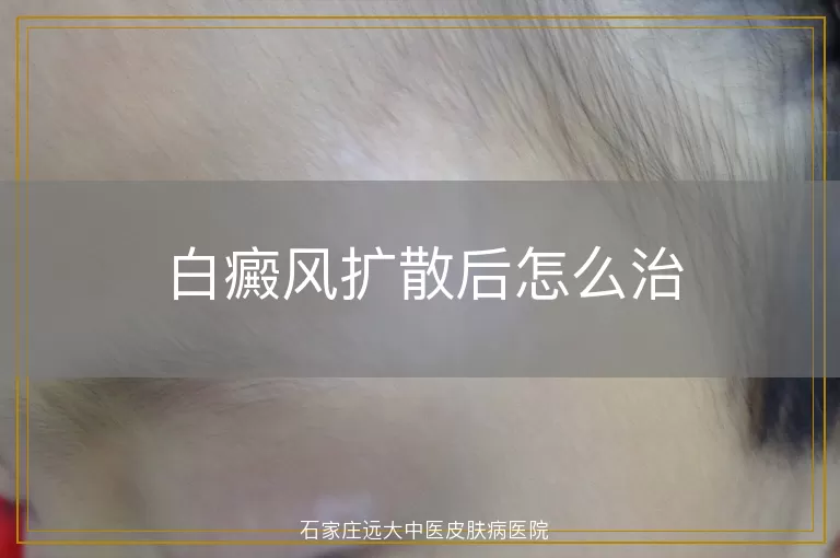 白癜风扩散后怎么治