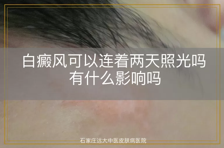 白癜风可以连着两天照光吗 有什么影响吗