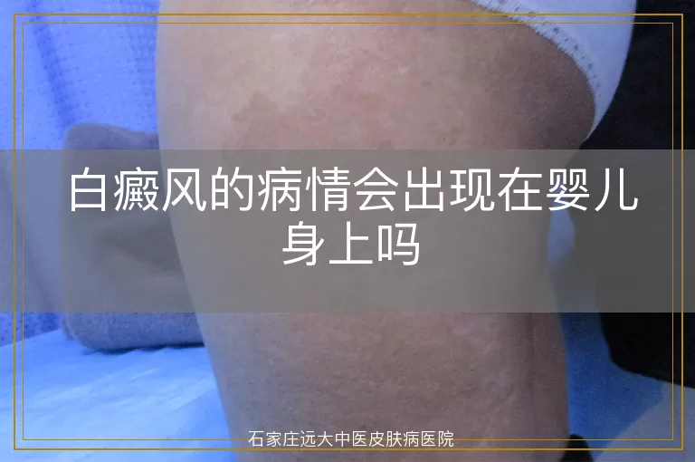 白癜风的病情会出现在婴儿身上吗