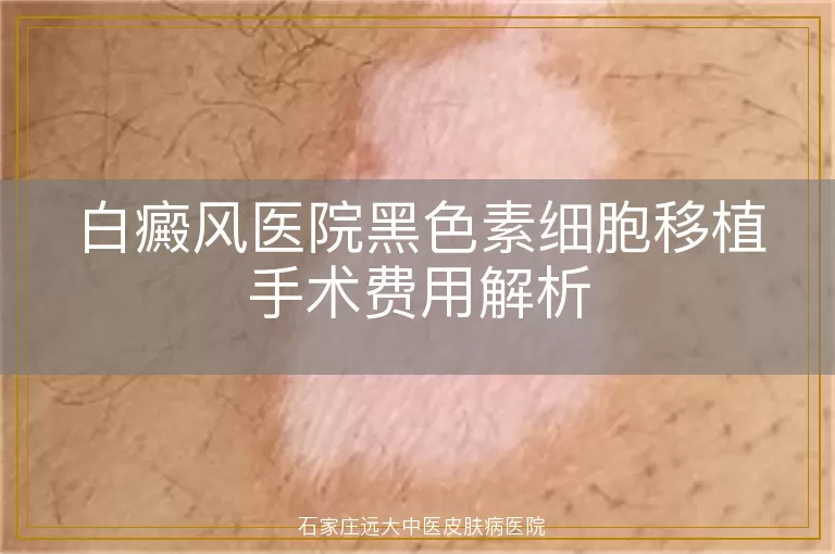 白癜风医院黑色素细胞移植手术费用解析