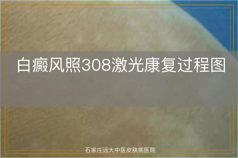 白癜风照308激光康复过程图