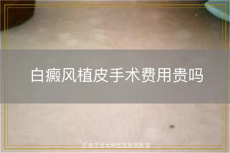 白癜风植皮手术费用贵吗