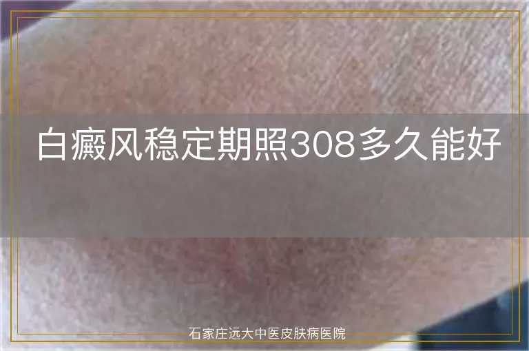 白癜风稳定期照308多久能好
