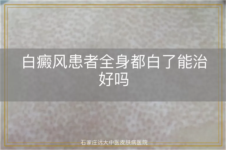 白癜风患者全身都白了能治好吗