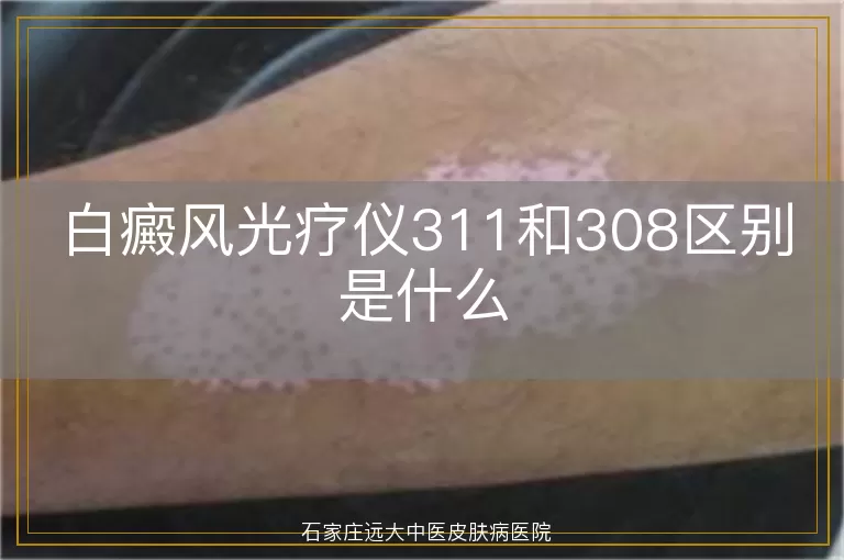 白癜风光疗仪311和308区别是什么