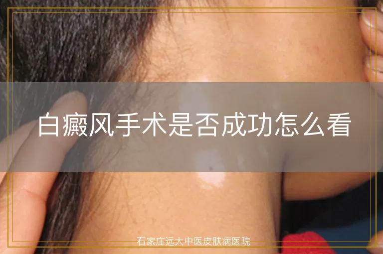 白癜风手术是否成功怎么看