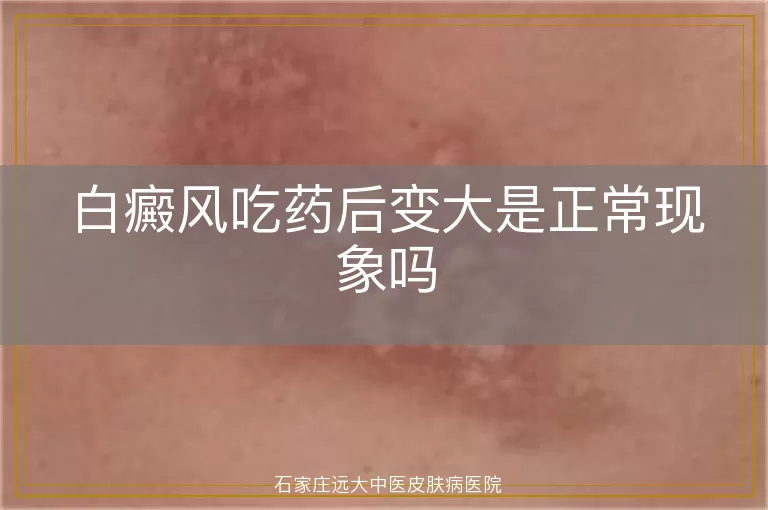 白癜风吃药后变大是正常现象吗